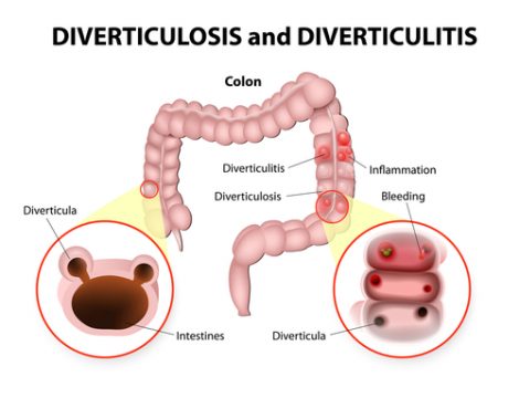 Prevent Diverticulitis Attacks Naturally