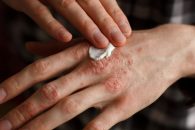 tips for treating psoriasis