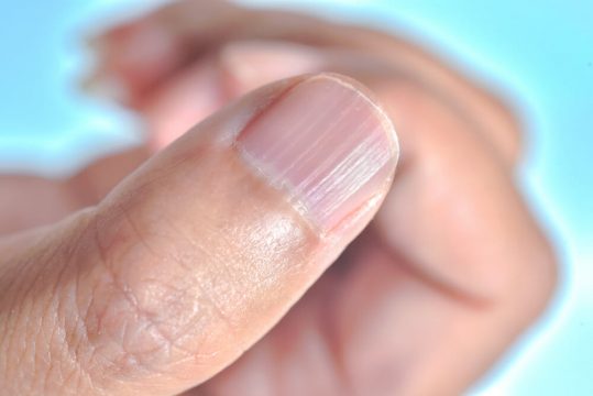 fingernail symptoms