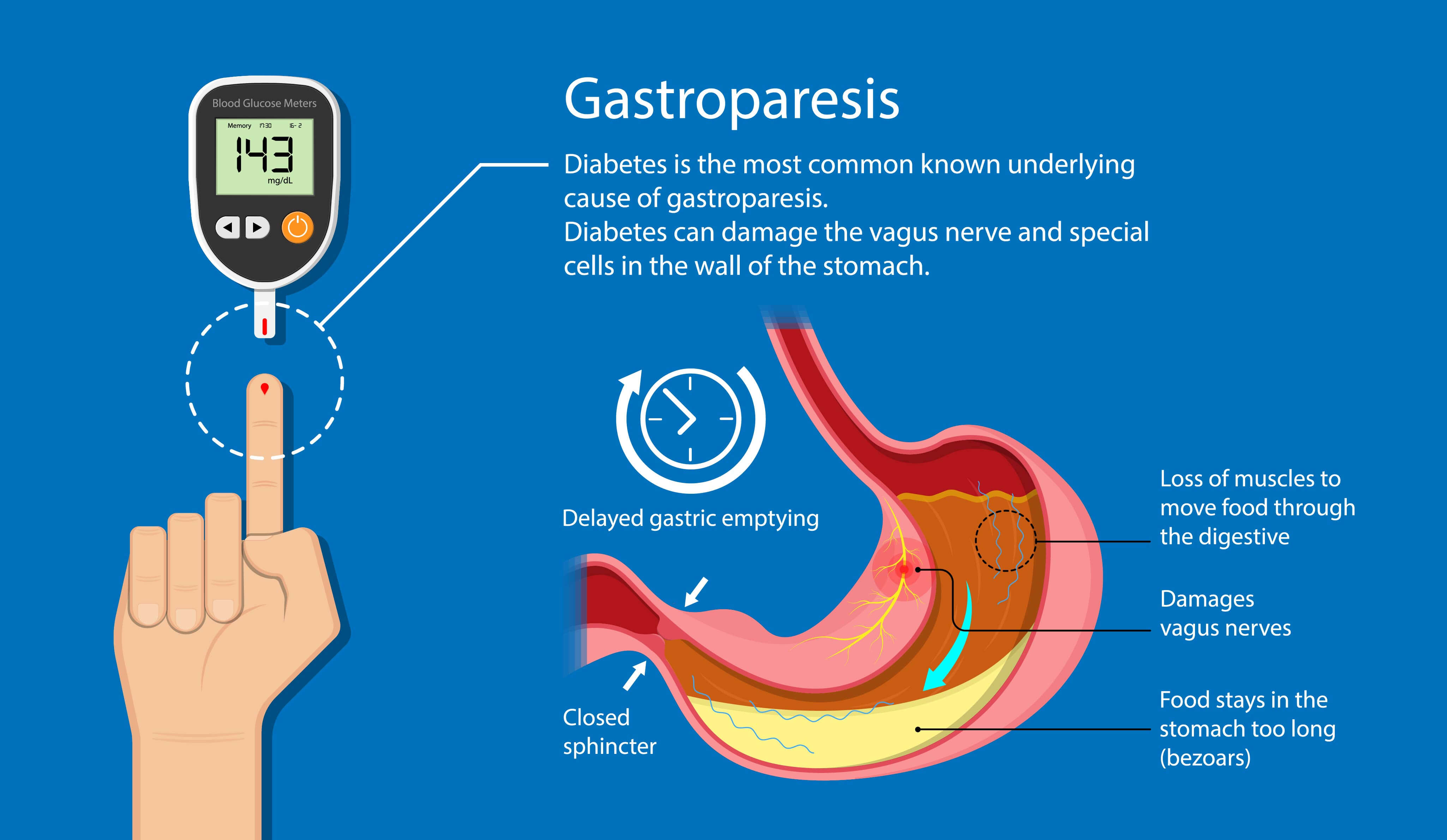 diabetic gastroparesis signs and symptoms
